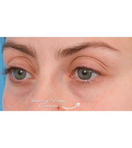 Tixel Before & After Patient #3841