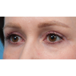 CO2 Laser Resurfacing Before & After Patient #3832