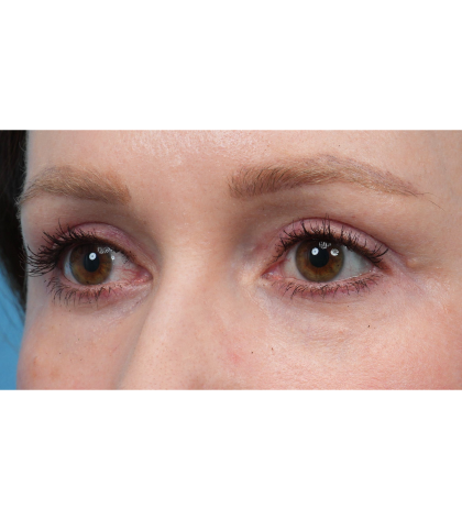CO2 Laser Resurfacing Before & After Patient #3832
