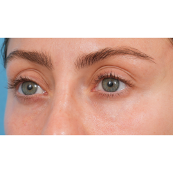 Tixel Before & After Patient #3841