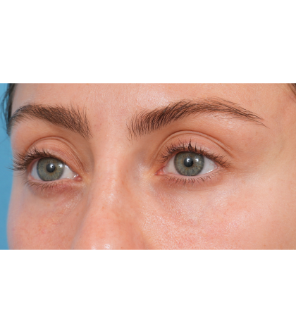 Tixel Before & After Patient #3841