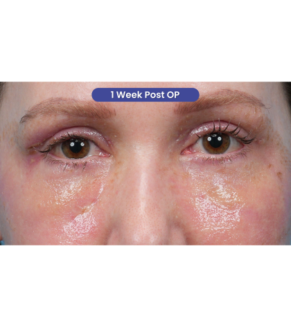CO2 Laser Resurfacing Before & After Patient #3832