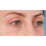 Tixel Before & After Patient #3841