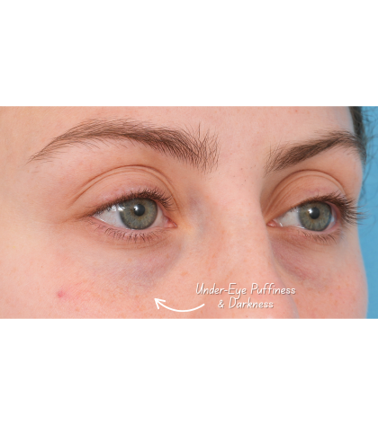 Tixel Before & After Patient #3841