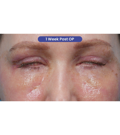 CO2 Laser Resurfacing Before & After Patient #3832