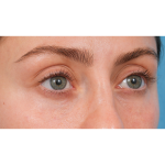 Tixel Before & After Patient #3841