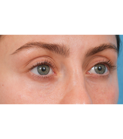 Tixel Before & After Patient #3841