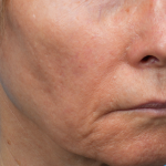 Sofwave Before & After Patient #3949