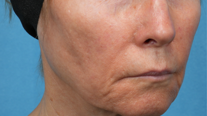 Sofwave Before & After Patient #3949