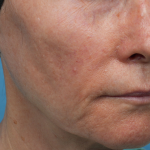 Sofwave Before & After Patient #3949
