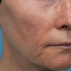 Sofwave Before & After Patient #3949
