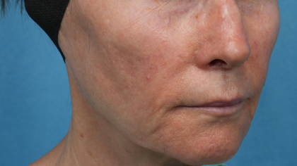 Sofwave Before & After Patient #3949