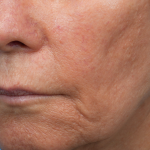 Sofwave Before & After Patient #3949