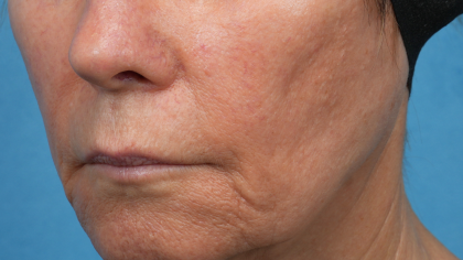 Sofwave Before & After Patient #3949