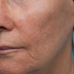 Sofwave Before & After Patient #3949