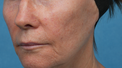 Sofwave Before & After Patient #3949
