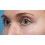 Vein Removal Before & After Patient #3954