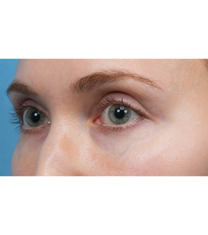 Vein Removal Before & After Patient #3954