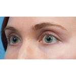 Vein Removal Before & After Patient #3954