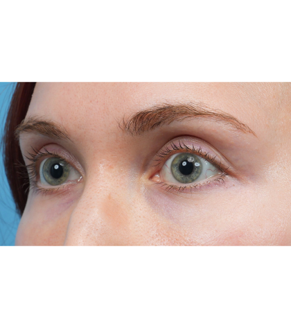 Vein Removal Before & After Patient #3954