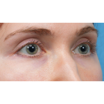 Vein Removal Before & After Patient #3954