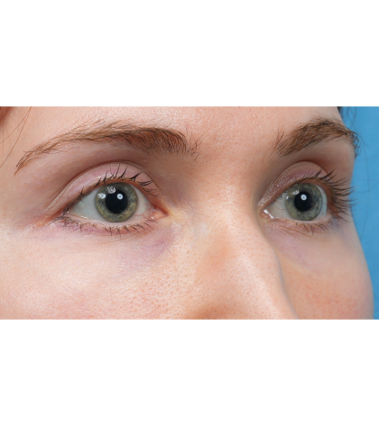 Vein Removal Before & After Patient #3954