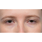 Ptosis Repair Before & After Patient #3885