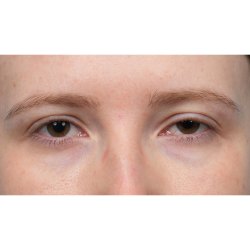 Ptosis Repair Before & After Patient #3885