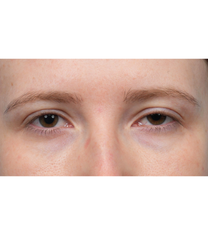 Ptosis Repair Before & After Patient #3885