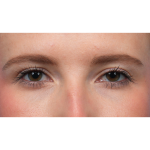Ptosis Repair Before & After Patient #3885