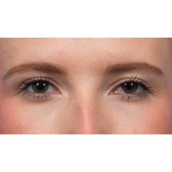 Ptosis Repair Before & After Patient #3885