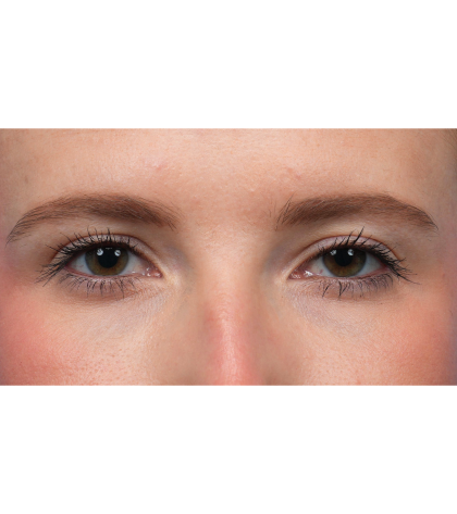 Ptosis Repair Before & After Patient #3885