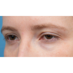 Ptosis Repair Before & After Patient #3885