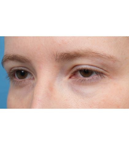 Ptosis Repair Before & After Patient #3885