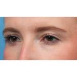 Ptosis Repair Before & After Patient #3885