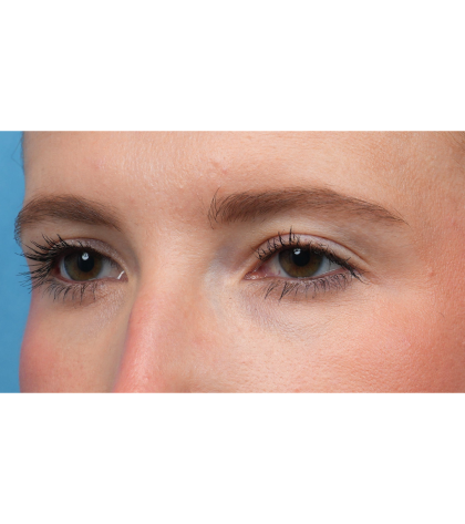 Ptosis Repair Before & After Patient #3885