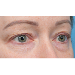 Fat Grafting Before & After Patient #3886