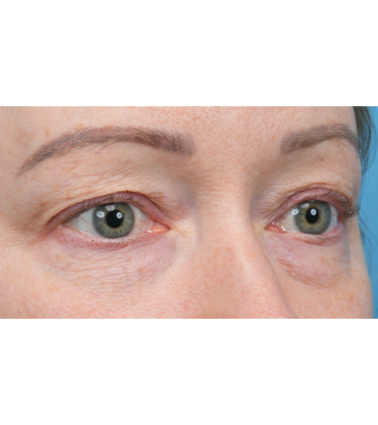 Fat Grafting Before & After Patient #3886