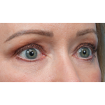 Fat Grafting Before & After Patient #3886