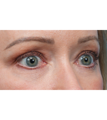 Fat Grafting Before & After Patient #3886