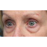 Lower Blepharoplasty Before & After Patient #3887