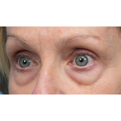 Lower Blepharoplasty Before & After Patient #3887