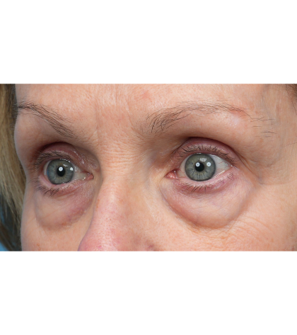 Lower Blepharoplasty Before & After Patient #3887