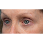 Lower Blepharoplasty Before & After Patient #3887
