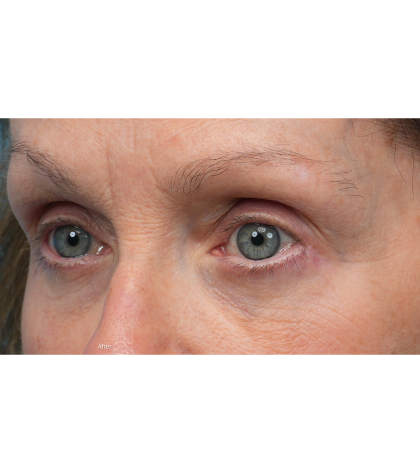 Lower Blepharoplasty Before & After Patient #3887
