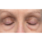 Lower Blepharoplasty Before & After Patient #3887