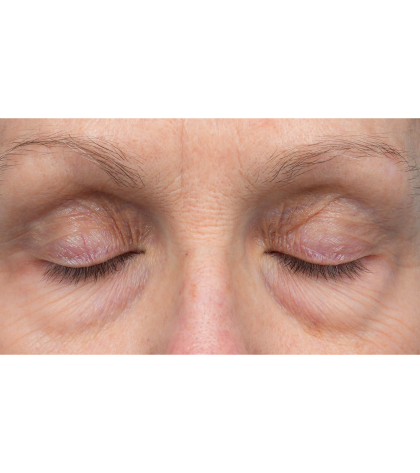 Lower Blepharoplasty Before & After Patient #3887