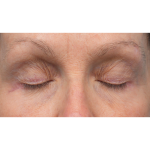 Lower Blepharoplasty Before & After Patient #3887