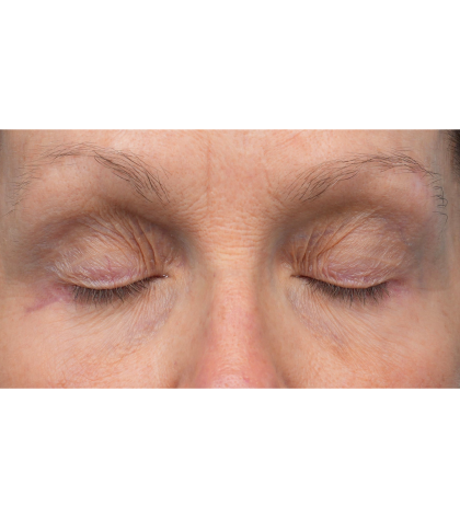 Lower Blepharoplasty Before & After Patient #3887