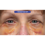 Lower Blepharoplasty Before & After Patient #3887